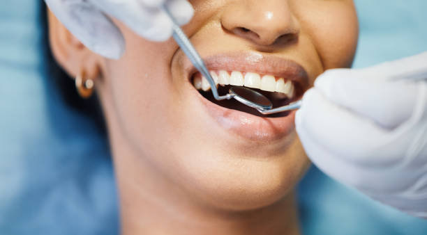 Best Knocked-Out Tooth (Avulsed Tooth) Treatment in Savannah, TX