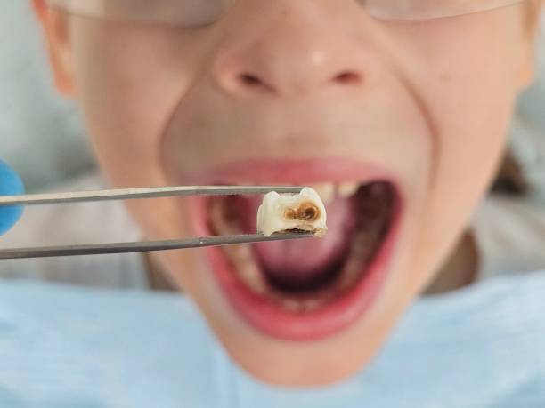Best Dental Abscess Treatment in Savannah, TX